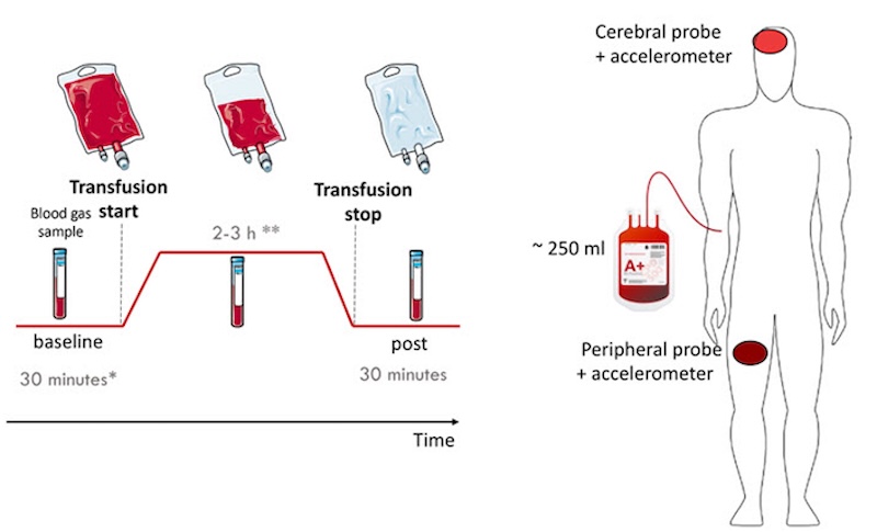 Hybrid diffuse optics enables probes for monitoring blood transfusion. Credit: ICFO/SPIE/Biophotonics Discovery.