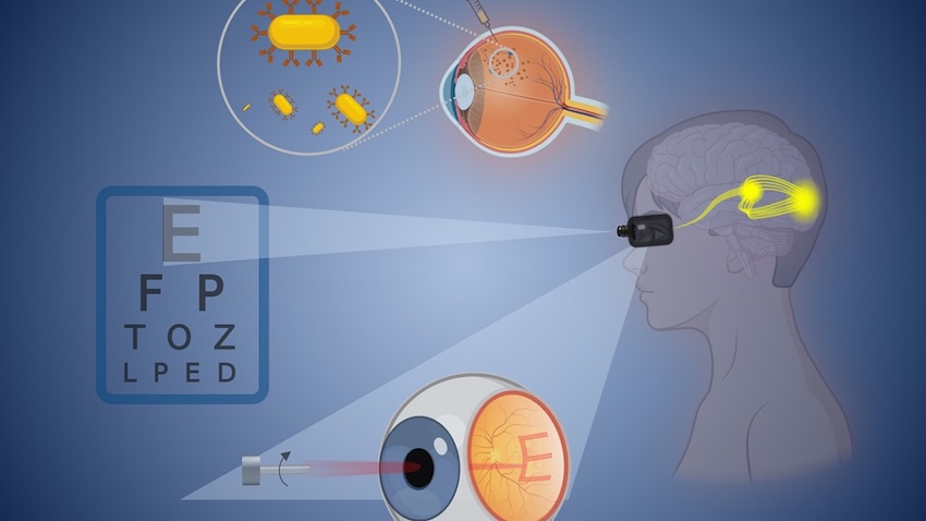 Injection of gold nanoparticles is a much simpler surgical procedure than full retinal prosthesis. Credit: Brown University/ACS Nano.