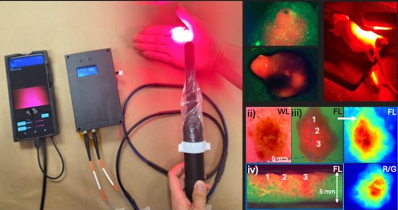 A newly developed intraoral device integrates diagnostic imaging and photodynamic therapy to detect and treat early-stage oral cancer. The handheld tool uses fluorescence imaging to identify lesions and delivers targeted light therapy to destroy cancerous tissue. Compact and affordable, it is designed for use in low-resource settings. Credit: SPIE Biophotonics Discovery.