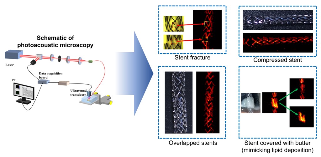 Researchers used photoacoustic microscopy to image stents through skin. They were able to visualize stents with fractures and compression and other clinical scenarios such as overlapped stents or conditions mimicking lipid deposition. Credit: Myeongsu Seong, Xi'an Jiaotong-Liverpool University/Optics Letters.