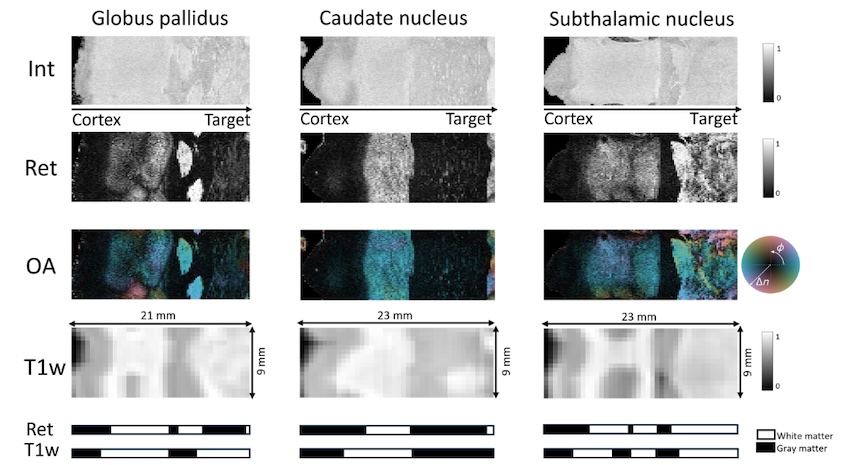 PS-OCT provides higher resolution and contrast images than MRI, as demonstrated in three common DBS targets: the subthalamic nucleus (right), the caudate nucleus (center), and the globus pallidus (left). Credit: Laval University/Neurophotonics.