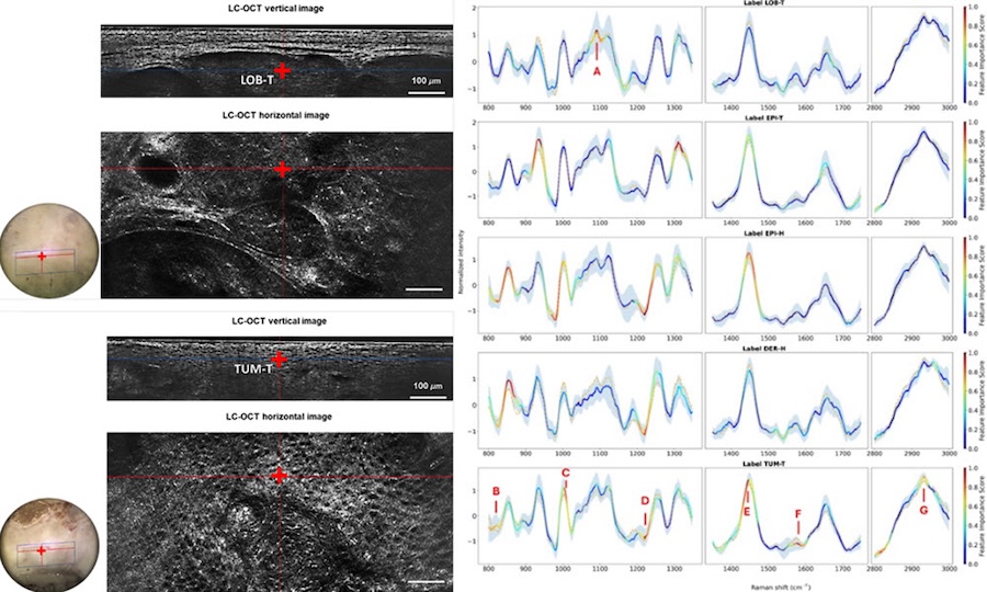 Line-field confocal optical coherence tomography (LC-OCT) captures high-resolution images of skin tissue at the cellular level, and then confocal Raman microspectroscopy analyzes the chemical makeup of specific areas identified in those images. Together, these tools enable insights into the shape and structure of cancerous cells. Credit: Journal of Biomedical Optics.