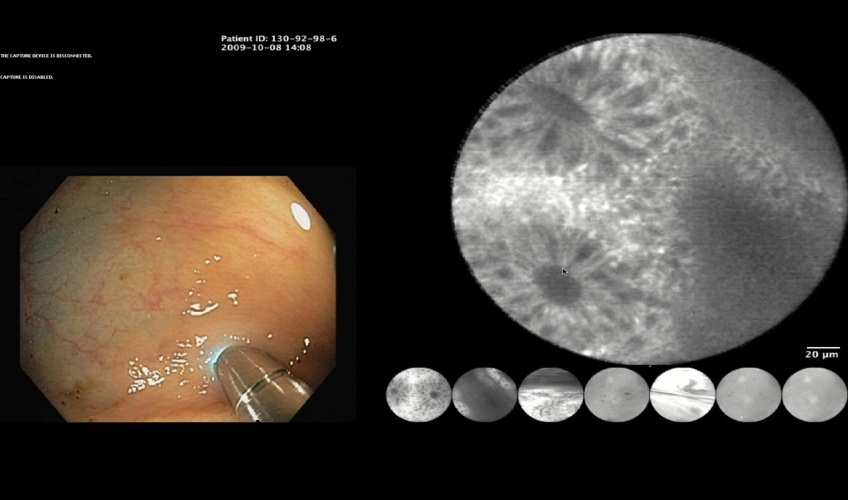 Conventional endoscopy (left) and confocal endomicroscopy (right). The new technique enables optical 