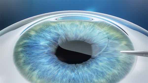 ReLEx smile replaces both the flap creation and the laser ablation processes in LASIK surgery with a controlled femtosecond laser technique, making for a smoother ride for patients. Credit: Carl Zeiss Meditec.