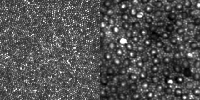 Adaptive optics has allowed a clearer view of individual retina cells. Left: the fovea region of the retina, showing the cone cells which are involved in forming sharp central vision. Right: a different area of the retina, in which the large bright dots with a dark ring around them are cones, and the more abundant smaller spots are rods. Credit: Alfredo Dubra, Medical College of Wisconsin