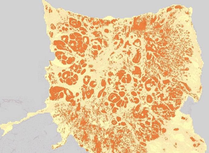 Tumor cell populations identified using Definiens image analysis from an stained pathology slide, with the tumor regions detected and now colored orange. The technology can be applied to tissues processed with conventional stains or fluorescence labels. Credit: Definiens. Image data courtesy of Charit&eacute; Berlin.