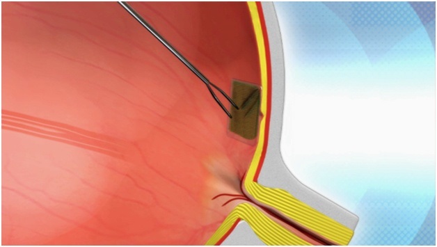Schematic diagram showing a bionic retina in a patient's eye (not Pixium's IRIS technology, which is currently in clinical trials). Credit: Nano Retina.