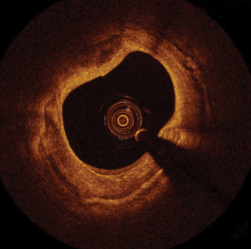 OCT images allow physicians to view the inside of a blood vessel. Credit: St Jude Medical.