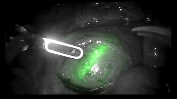Fluorescence can assist surgeons in locating vital blood vessels, such as the inferior mesenteric artery during certain colorectal procedures, in order to avoid doing unnecessary damage. Credit: Dr. Giuseppe Spinoglio, Alessandria National Hospital, Italy/Jonathan Sorger.