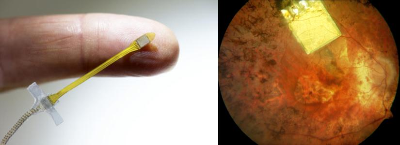 Retina Implant's microchip is implanted below the retina, in the macular region where light-sensitive photoreceptor cells are located. Credit: Retina Implant.