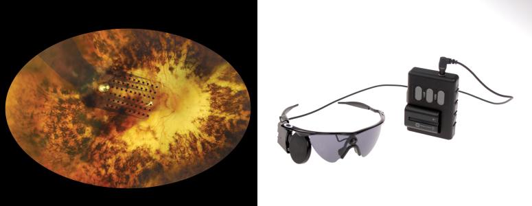 The epiretinal implant is intended to directly stimulate the ganglional cells that are the output layer of the retina. Credit: Second Sight.