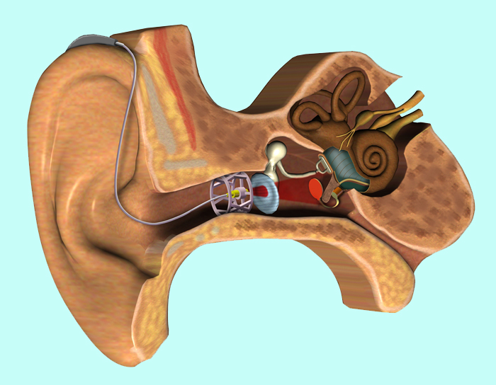 The aid comprises three parts: microphone with battery; wireless, optical signal and energy transmission between outer and middle ear via infrared signal; and an electro-acoustic transducer - the centerpiece and loudspeaker of the implant. 