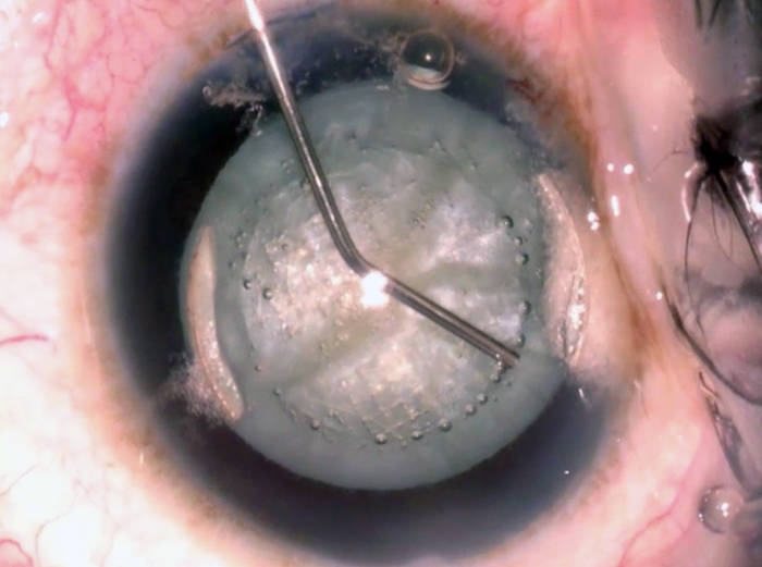 The start of the lens removal stage in a cataract patient, using OptiMedica's Catalys femtosecond laser system. Credit: OptiMedica.