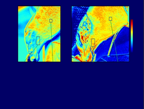 Hyperspectral image-guided surgery: surgeons using HSI to visualize areas of oxygenated and ischemic skin were able to save a patient's toe from amputation. In this image, red areas show high levels of oxygenation. Credit: Javier La Fontaine.