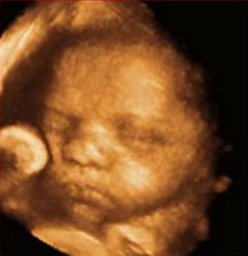 Laser treatment reduces risk of disability in affected twin fetuses.