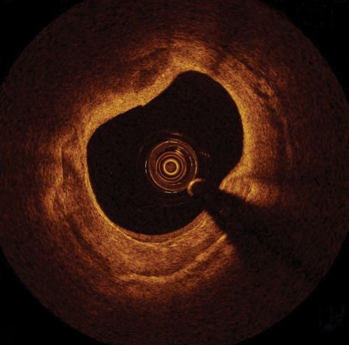 The inside of a blood vessel, imaged using OCT. Credit: St Jude Medical.
