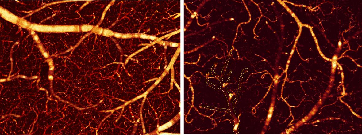 3D ODT images of the motor cortex from (left) a control mouse brain, and (right) a chronic cocaine treated mouse showing significant decreases in the entire CBFv network. Area shown 2 x 1.5 x 1 cubic millimeters. Credit: Yingtian Pan/Biomedical Optics Express.