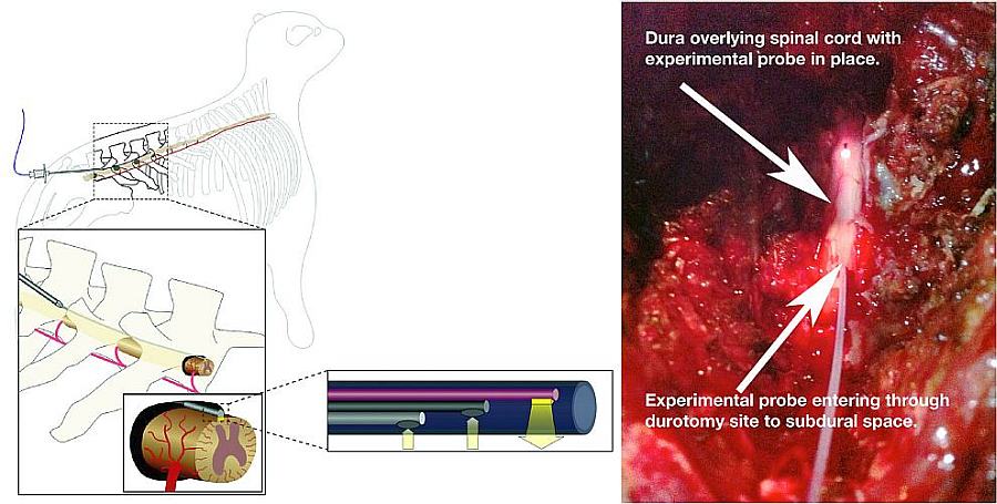 Left: a schematic of the experiment, featuring the instrument and its thin fiber-optic probe. Right: the probe in place under outer dura of the spine. Credit: Thomas Floyd/Stony Brook Medicine.