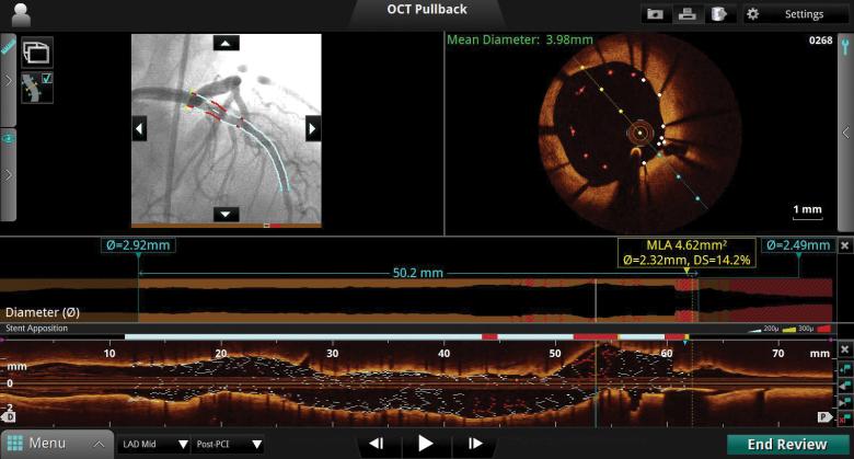 St Jude Medical OCT software features automated measurements, co-registered angiography views and new stent deployment features. Credit: St Jude Medical/Business Wire.