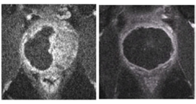 Magnetic resonance images of a prostate gland, before (l) and after (r) treatment with Tookad Soluble and PDT. The central black regions in the right image show how cancerous tissue previously occluding the prostate have been eliminated. Image: Weizmann Institute of Science.