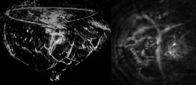 Volumetric images of the breast taken by a TomoWave clinical optoacoustic imaging system, including (at right) section of the breast showing a tumor and the associated vasculature. Credit: Alexander Oraevsky/TomoWave Laboratories.