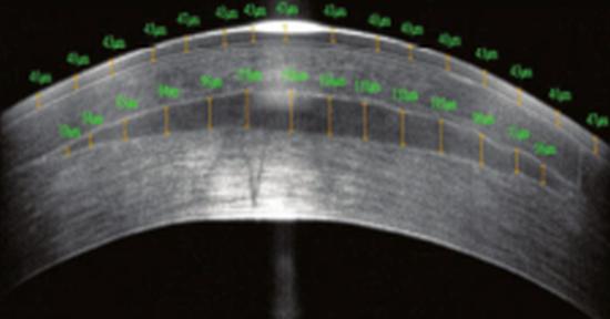 Biocompatible implants produced from donor human corneas can tackle prebyopia and other vision disorders, as an alternative to existing hydrogel implants. Credit: David Muller/Allotex.