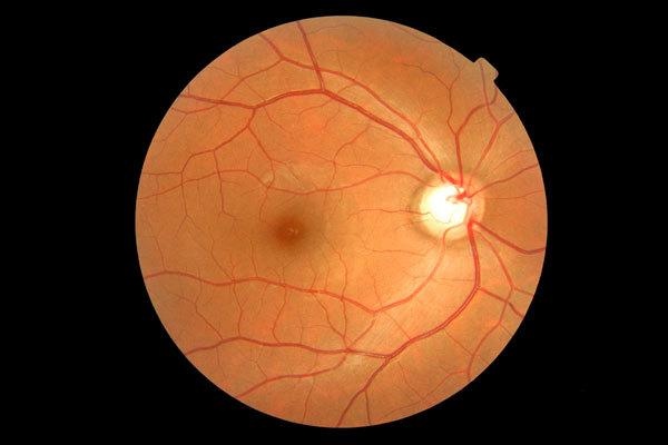 Retinal imaging is critical for diagnosing sight-threatening diseases like glaucoma, but tends to require expensive imaging equipment. Broadspot Imaging says that its optics expertise will allow it to offer ophthalmology examinations at much lower cost. Photo: NeoVision Eye Center.