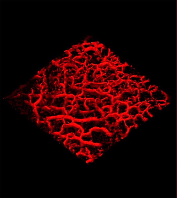 The new OCT platform allows clinicians to image the blood flow around melanomas, as well as at the sites of other skin conditions. Credit: Michelson Diagnostics/VivoSight.