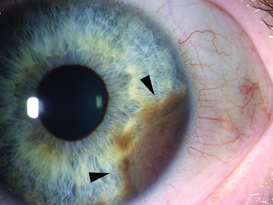 According to the web site skincancer.org, uveal melanoma is the most common primary intraocular cancer, and the second most common form of melanoma. Difficult to treat, and with poor survival rates in patients where the disease has spread to the liver, this form of melanoma is regarded as aggressive and presenting an unmet clinical need. Auro Biosciences