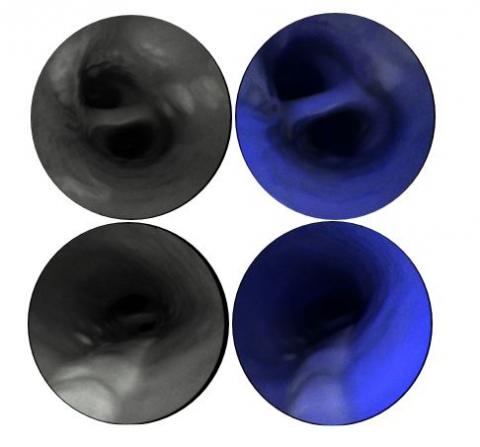 Scanning fiber angioscopic images with red reflectance for structural images (left) and blue fluorescence for label-free biochemical contrast (right). Images demonstrate multiple atherosclerotic lesions with very low fluorescence in the blue spectrum in comparison to the surrounding healthy artery. Credit: University of Michigan.