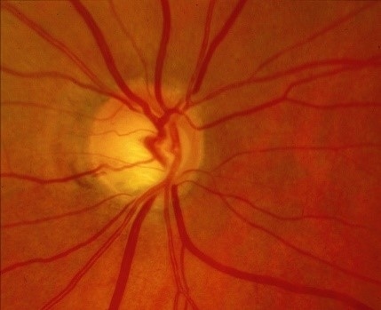 Damage caused by glaucoma. The Israeli startup company Belkin Laser believes that its rapid, automated treatment system could replace the use of eye drops as a 