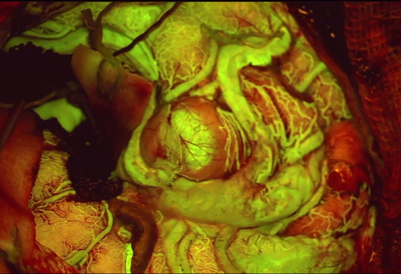 View of an arteriovenous malformation (AVM) under FL560 fluorescence, highlighting small blood vessels. Photo courtesy of Cleopatra Charalampaki, MD, PhD, Professor of Neurosurgery, Department of Neurosurgery, Cologne Medical Center, Germany.