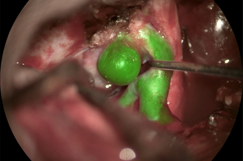 Leica's next generation of surgical microscopes is expected to feature augmented reality fluorescence imagery overlaid on white-light visualization, to help neurosurgeons see features like aneurysms (as shown here) more clearly. Photo courtesy of Cleopatra Charalampaki, MD, PhD, Professor of Neurosurgery, Department of Neurosurgery, Cologne Medical Center, Germany.