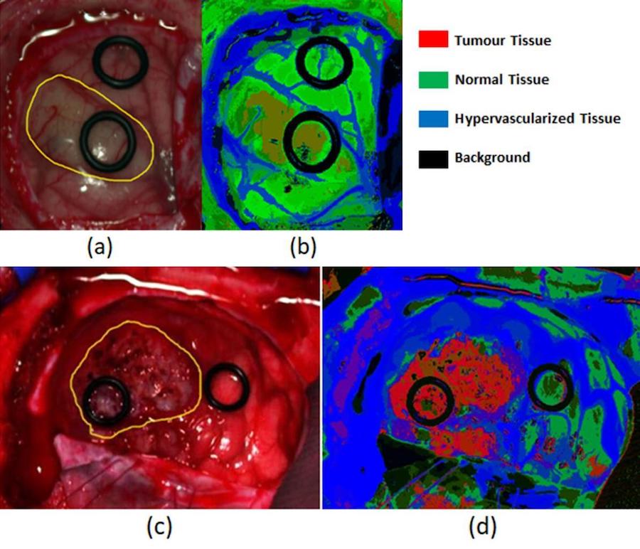 RGB images (a and c) of two different patients with the tumor area surrounded in yellow. HELICoiD density maps (b and d) obtained after the image processing of the corresponding hyperspectral images. Credit: HELICoiD Project.