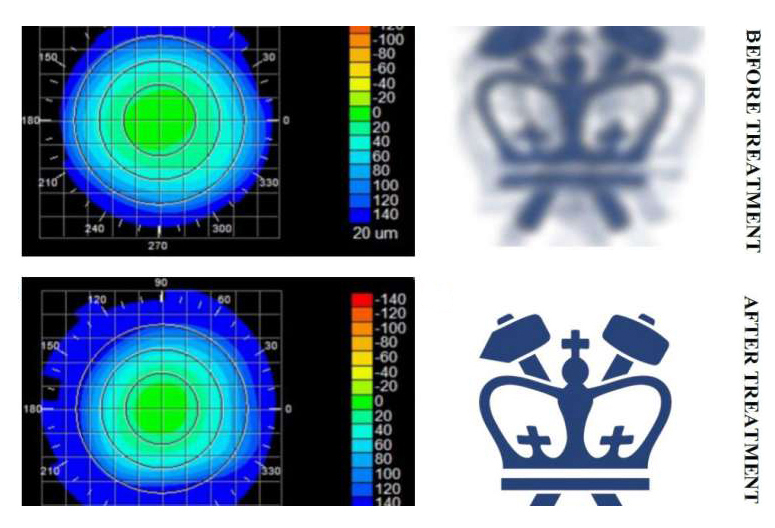 Eyes right: Corneal topography before and after the treatment, paired with virtual vision that simulates effects of induced refractive power change. Image credit: Sinisa Vukelic/Columbia Engineering.