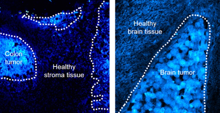 DO-SRS reveals the increased levels of deuterium incorporated into the proteins and lipids of malignant tissues in the colon and brain of animals, revealing tumor margins more precisely. Credit: Min Lab/Columbia.