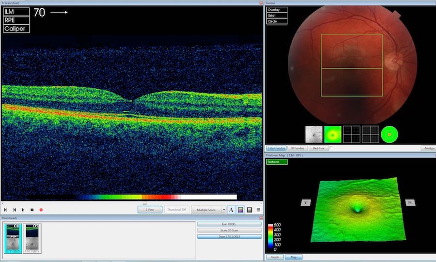 AI interpretation of OCT scans could potentially transform the management of sight-threatening eye disease. Credit: Moorfields Eye Hospital/DeepMind.