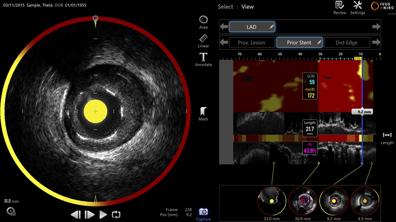 Ultrasonic intravascular imaging is used to determine the degree to which arteries are blocked by plaques, but the specific chemical nature of those plaques is thought to be critical in deciding whether or not the blockage will lead to a serious cardiac event such as a heart attack. Infraredx's dual-mode technology combines ultrasound with near-infrared spectroscopy to detail both the blockage and its chemical make-up. Image: Infraredx.