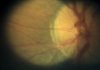 digital image of the retina