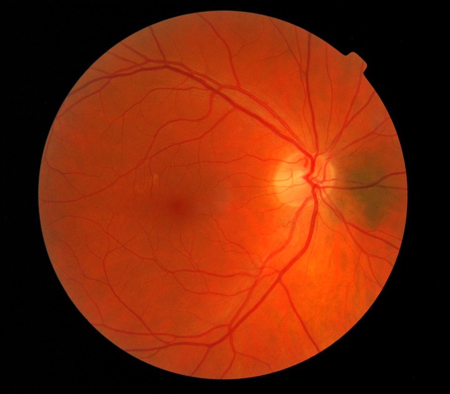 Retina blood flow: vital for diagnosis