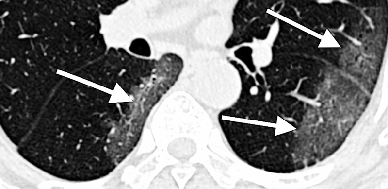 Tell-tale signs: CT scan of lungs of Covid-19 patient.