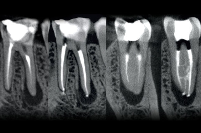 Laser-assisted root canal treatment