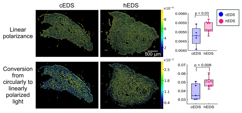 Representative polarization images to distinguish between cEDS and hEDS skin biopsies.
