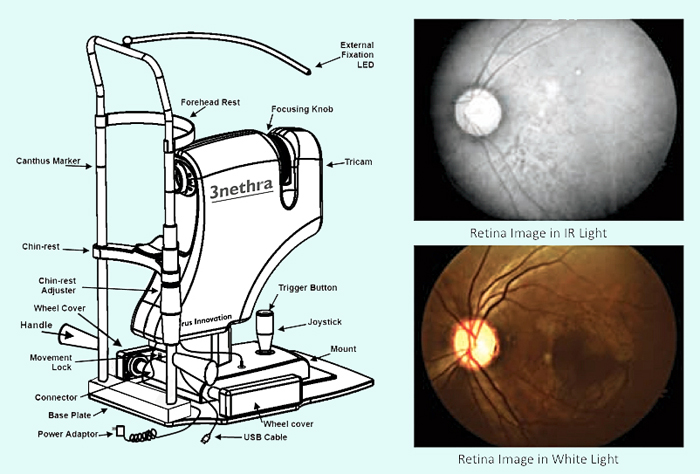 3nethra is a low cost, portable, and integrated ophthalmology device.