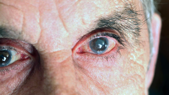 Laser treatment of cataracts 