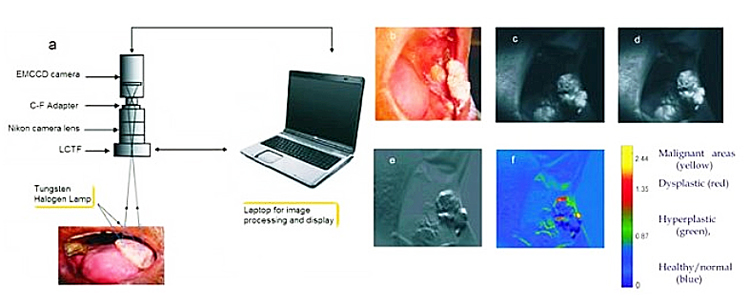 Non-invasive spectral imaging system enables mass screening for oral cancers.
