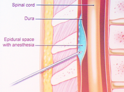 Positioning an epidural needle is critical for effective pain relief.
