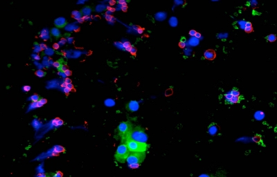 Fluorescent melanoma cells