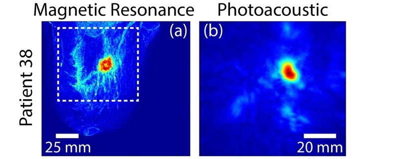 Photoacoustics for breast cancer diagnosis