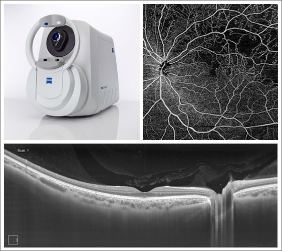 Eye resolution: Zeiss Plex Elite 9000 Swept-Source OCT and retina images.